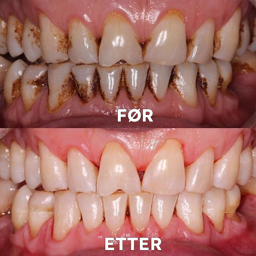 ✅Offisiell butikk | Ourlyard™ Tannhelse Mineralpulver🧑🏽⚕️Godkjent av Legemiddelverket (Behandler periodontitt og munnsår, forebygger tannfall og reparerer tannkjøttresesjon)