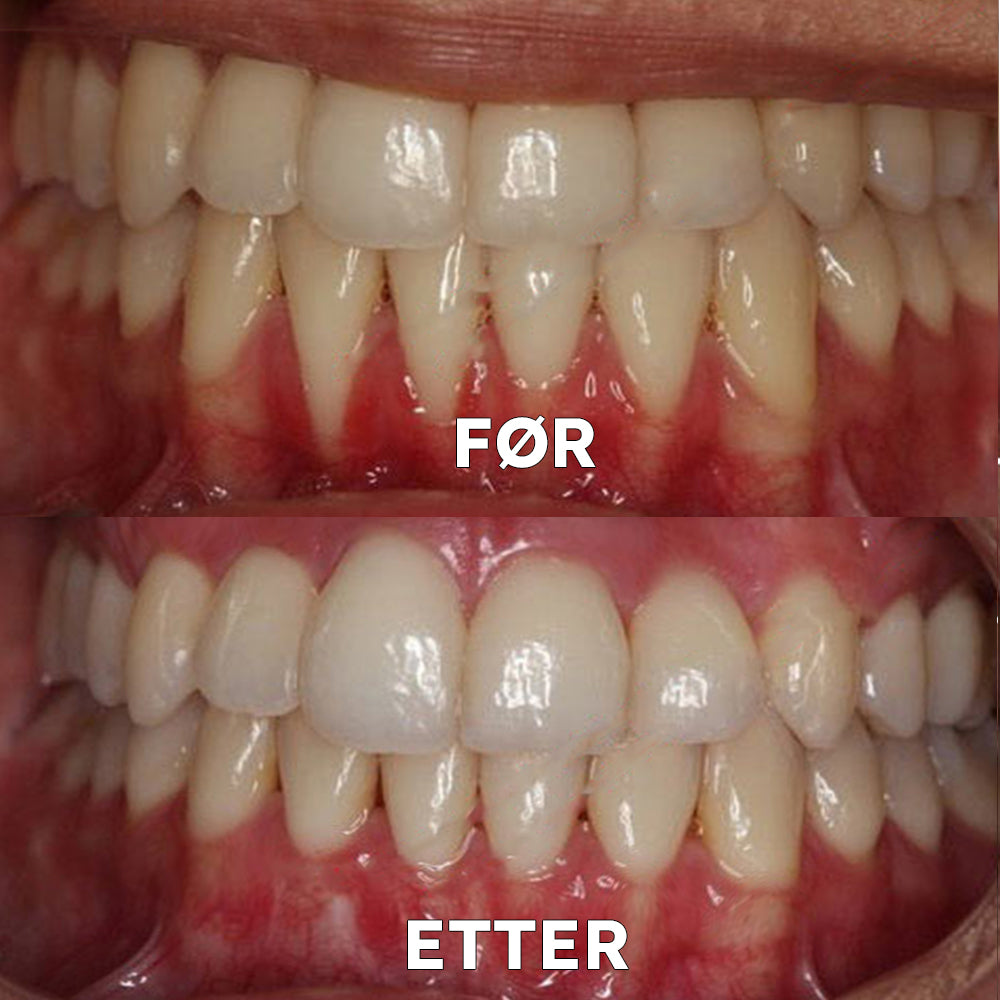 ✅Offisiell butikk | Ourlyard™ Tannhelse Mineralpulver🧑🏽⚕️Godkjent av Legemiddelverket (Behandler periodontitt og munnsår, forebygger tannfall og reparerer tannkjøttresesjon)