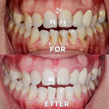 ✅Offisiell butikk | Ourlyard™ Tannhelse Mineralpulver🧑🏽‍⚕️Godkjent av Legemiddelverket (Behandler periodontitt og munnsår, forebygger tannfall og reparerer tannkjøttresesjon)